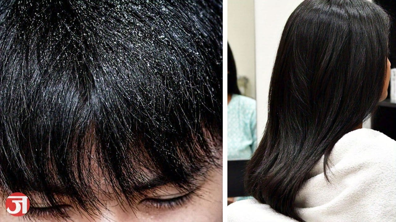 डैंड्रफ