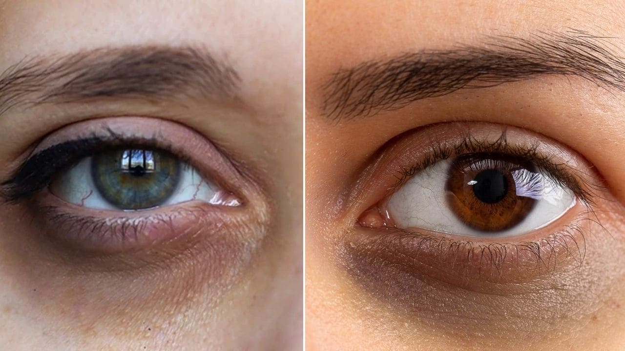 आप भी आंखों के नीचे काले धब्बे से है परेशान, यह 7 नुस्खे आपके लिए होंगे रामबाण साबित